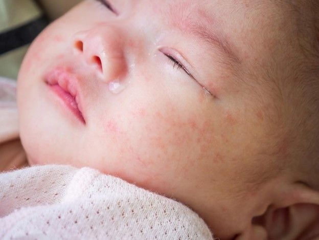 Photo newborn baby with dermatitis allergy on face - Baby Acne