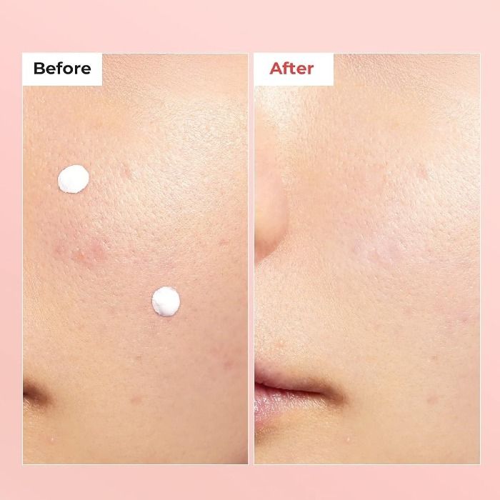 facial skin with silver patches - Korean skincare for acne