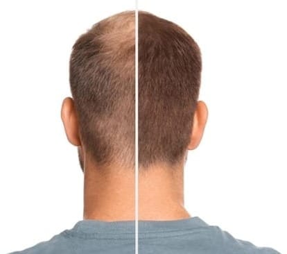 Photo man with hair loss problem before and after treatment on white background collage visiting trichologist