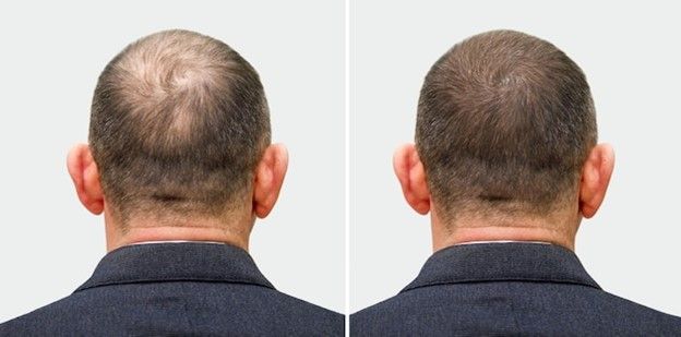 man with hair loss before and after - biotin oil for hair growth