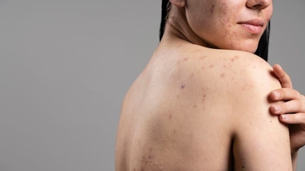 Side photo of woman with body acne showing shoulder