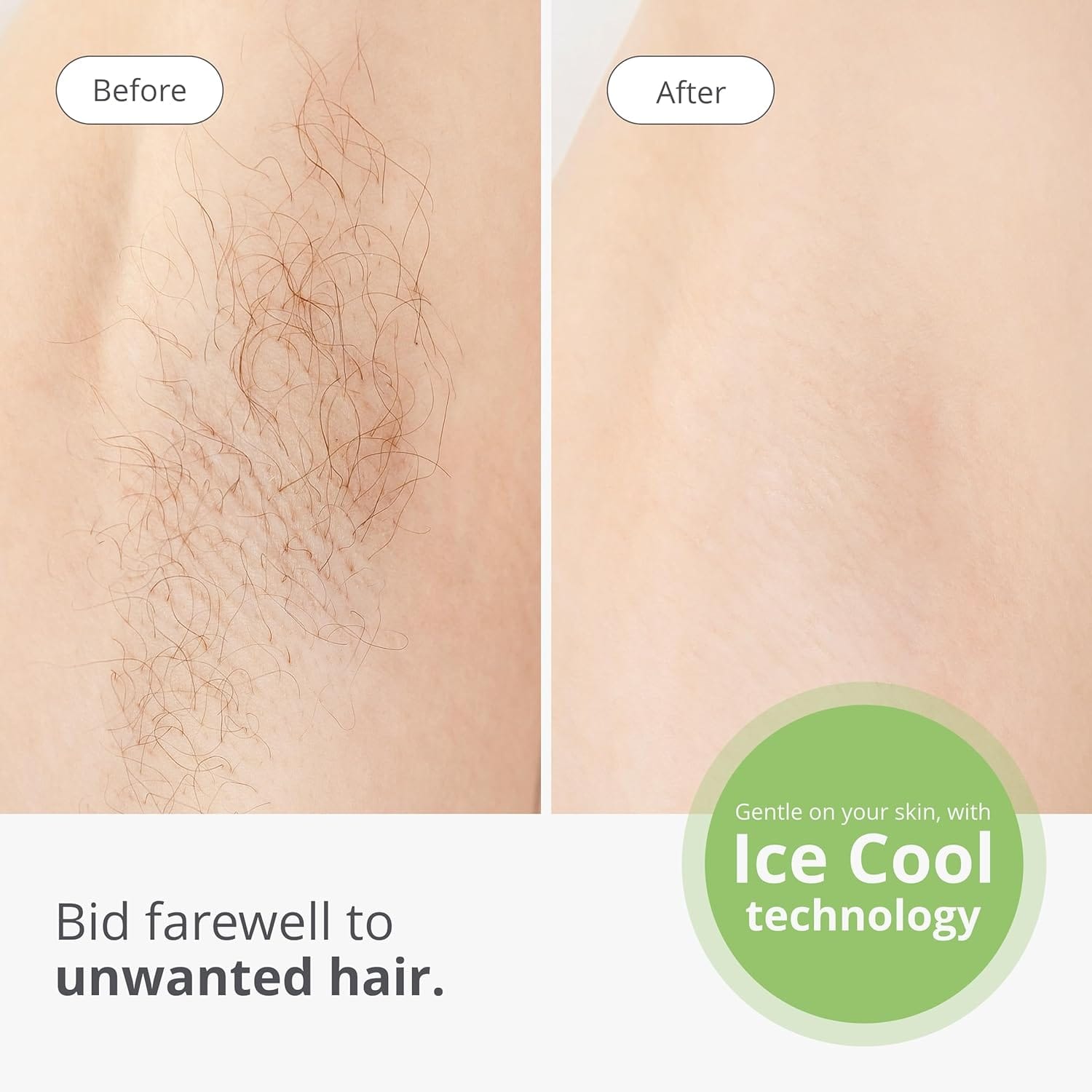 Tria Beauty Advanced IPL-S Hair Removal Device - before and after underarm treatment Best Skin Care Devices