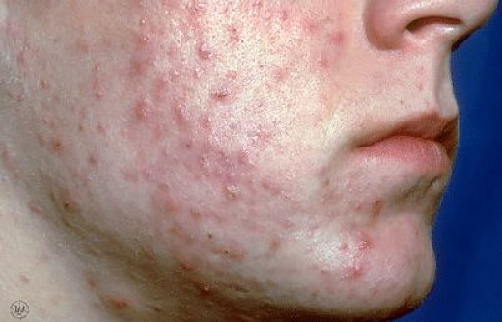 Person with Severe Facial acne - Exfoliants to Heal Adult Acne Skin