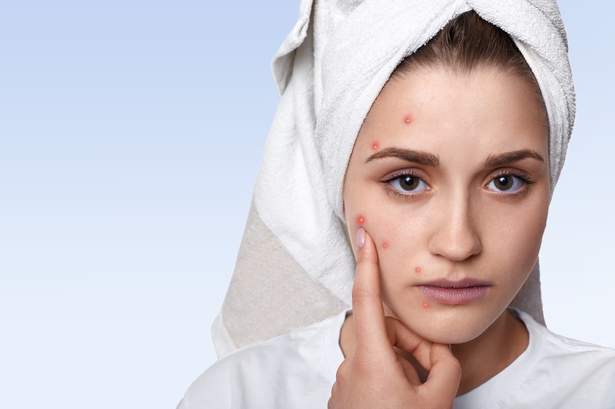 Adult Acne: Over-the-Counter Solutions To Help You Take Control - girl pointing finger at pimple