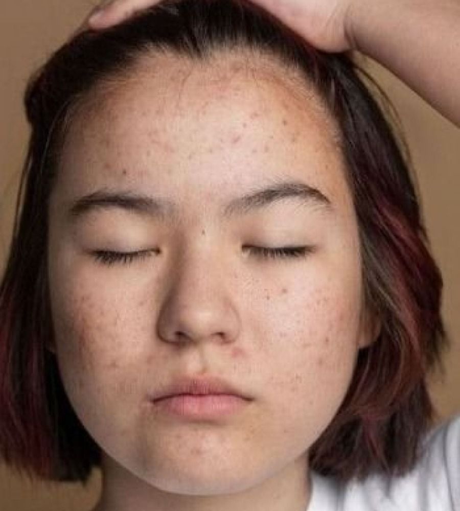 close up picture on girl face with pimples and large pores