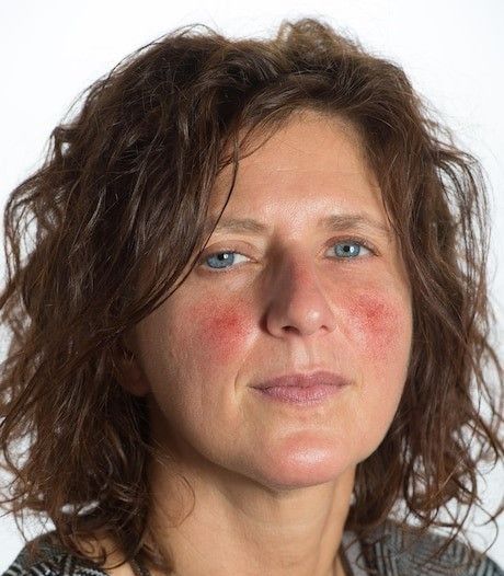 Calm Your Glow: A Holistic Approach to Manage Rosacea