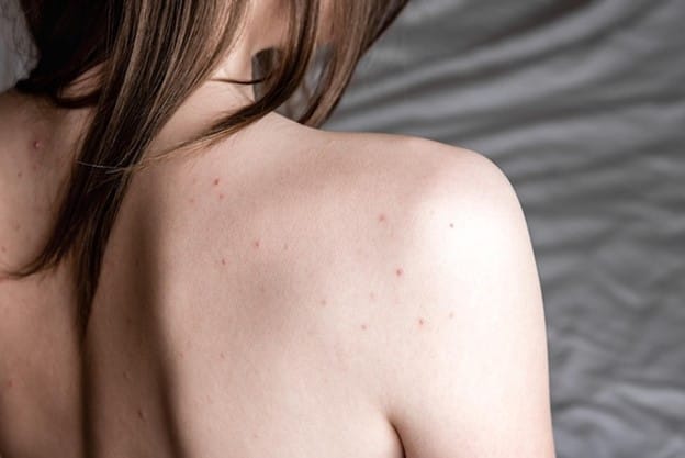 Photo body acne on young woman's back with acne, pimples and red spots.